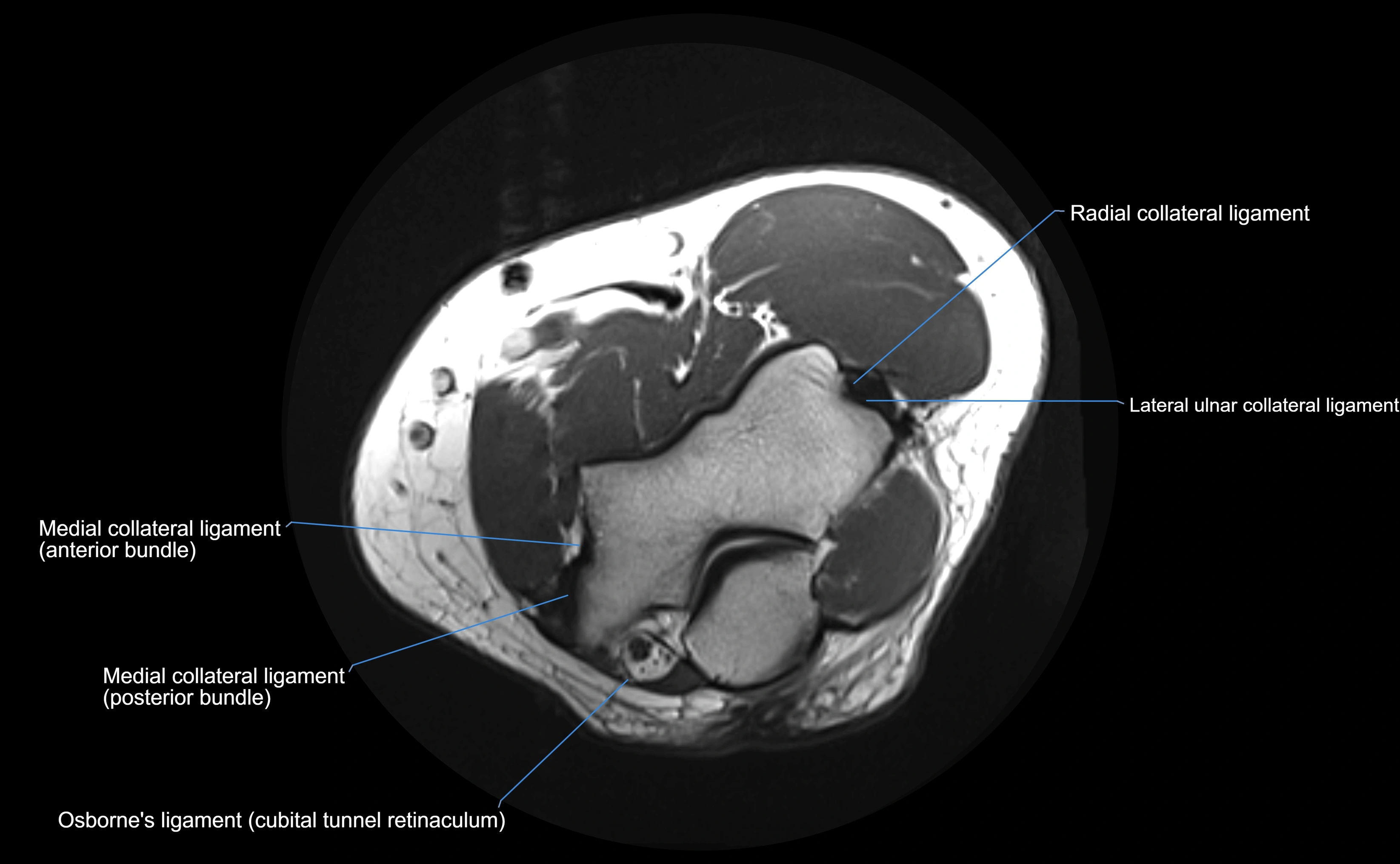 MRI elbow ligaments axial cross sectional anatomy 3T  radiology  image-img-00001-00013.webp